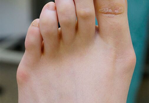 Valgus Fouss