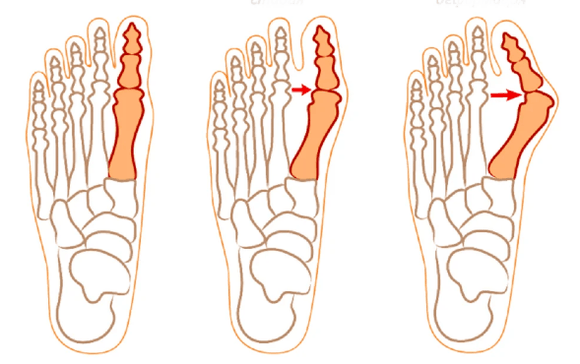 Hallux Valgus Deformitéit