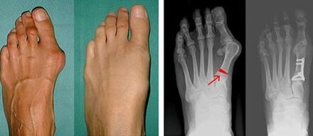 Symptomer vun Hallux valgus