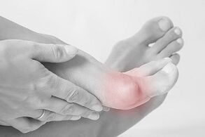 Hallux valgus Wéi wielen ech Schong