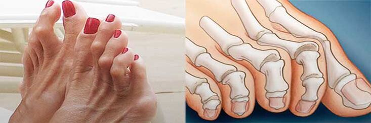 Hammertoe Deformitéit