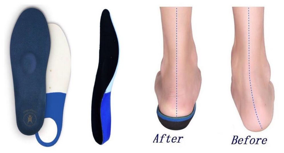 Orthopädesch Insoles fir Plano-valgus Foussdeformitéit