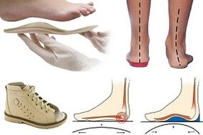 orthopädische Schong fir Hallux valgus an engem Kand