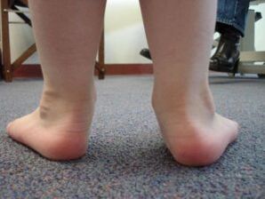 Flaach valgus Fouss Deformitéit an engem Kand