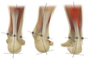 Normale Fouss, mat valgus a varus Ofwäichung vum Calcaneus