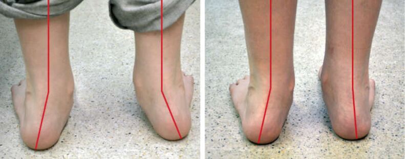 Valgus Been