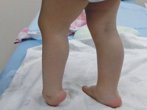 Déi éischt Symptomer vun der Valgus Deformatioun vum Fouss