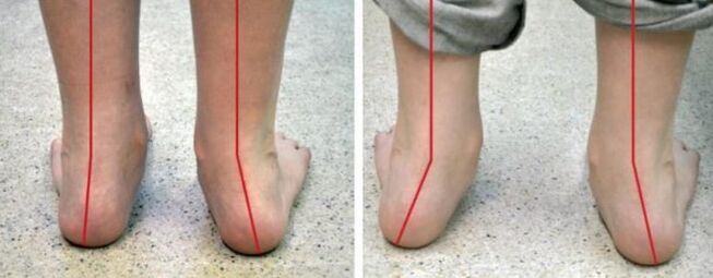 Valgus Fouss